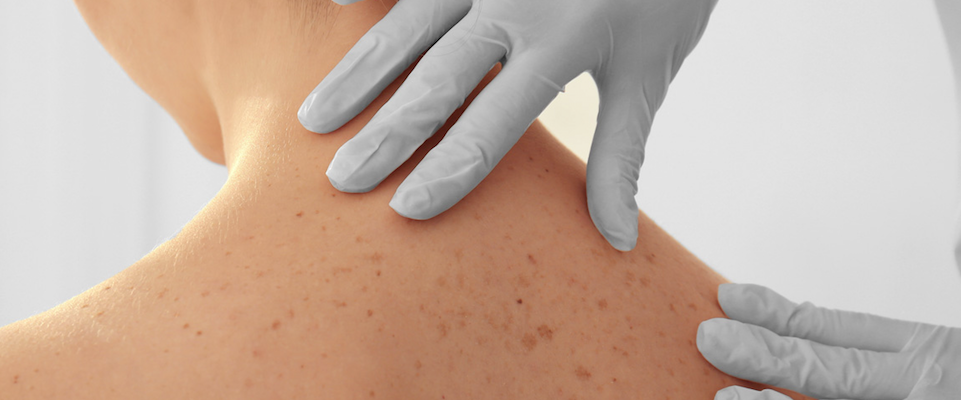 Psoriasi: al congresso dei dermatologi annunciata una nuova molecola