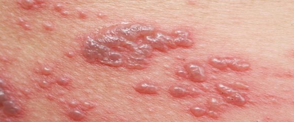 Estate, attenzione al sapore di sale sulla pelle. In 5 milioni a rischio orticaria