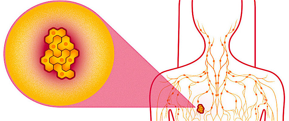 Tumore al seno, arriva una nuova terapia che dà speranze concrete di sopravvivenza